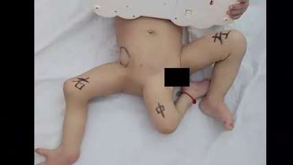 shocking News | Boy’s third leg is finally removed in pioneering surgery