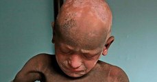 Une étrange et rare maladie fait que ce jeune garçon se transforme petit à petit en pierre !