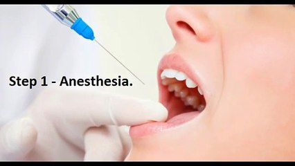 Dental Implant Procedure - Step by Step Guide