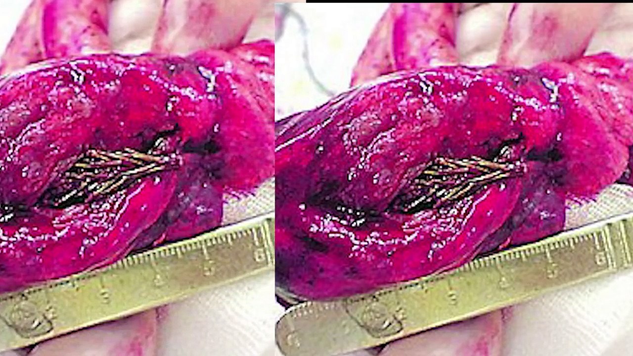 15 Shocking Things Found Inside Human Bodies