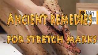 Get rid of STRETCH Marks QUICKLY! | VERY Effective