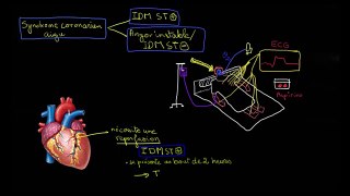 Traitement infarctus du myocarde : médicaments de lurgence, thrombolyse et traitement au long cours