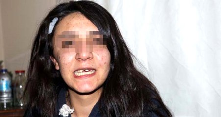 Erkek Arkadaşı Tarafından Dişi Kırılan Genç Kızın İsyanı: Korunmaya İhtiyacımız Var