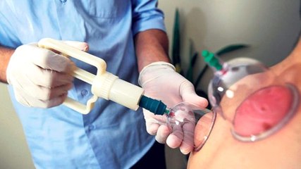 Bakanlık Harekete Geçti!  Hacamatçılar Kapanacak, Aile Hekimleri Hacamat Yapacak