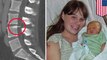 Mom finds epidural needle lodged in spine 14 years after giving birth