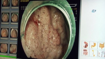 Mide ve kolon kanserine ameliyatsız çözüm