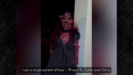 Hastalığı Yüzünden Tanınmaz Hale Geldi, Kendisine Yardımcı Olacak Birilerini Arıyor