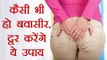 Piles : खूनी और मस्से वाली बवासीर से छुटकारा दिलाएंगे ये उपाय | Home remedies for piles |Boldsky