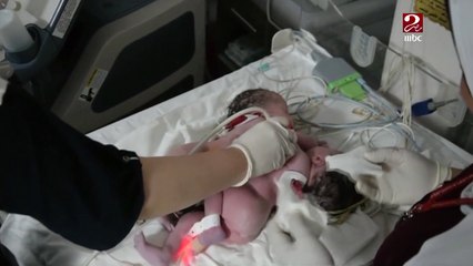 مستشفى الأطفال الجامعي بالمنصورة تجري جراحة لفصل تؤأم ملتصق