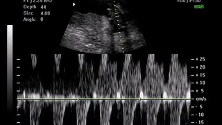 12 Weeks Pregnant Gender Determination Ultrasound