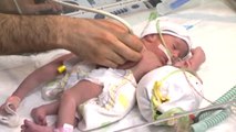 Ameliyatla Ayrılan Suriyeli Siyam İkizlerinden Biri Öldü