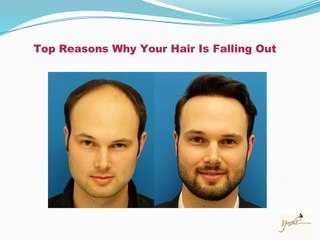 Top reasons why your hair is falling out
