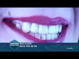 Diş Araları Kapatma Ve Diş Beyazlatma | Günaydın Doktor