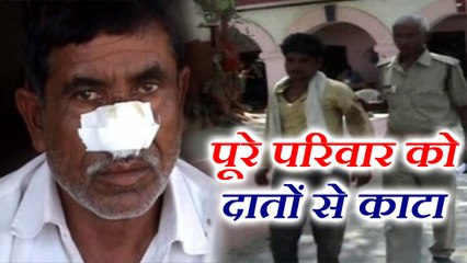 बड़े भाई ने कहा कुछ ऐसा कि छोटे भाई ने दांत से काट ली उसकी नाक