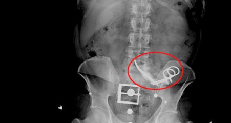 Bel Ağrısı ile Doktora Gitti, Karnından 23 Yıl Önce Ameliyatta Unutulan Makas Çıktı