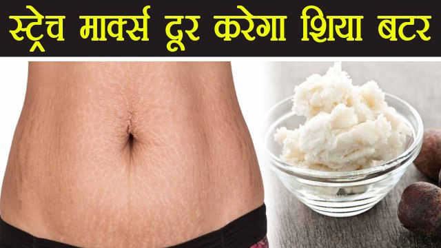 Shea Butter for Stretch Mark | शिया बटर के इस्तेमाल से मिलेगा स्ट्रेच मार्क्स से छुटकारा | Boldsky