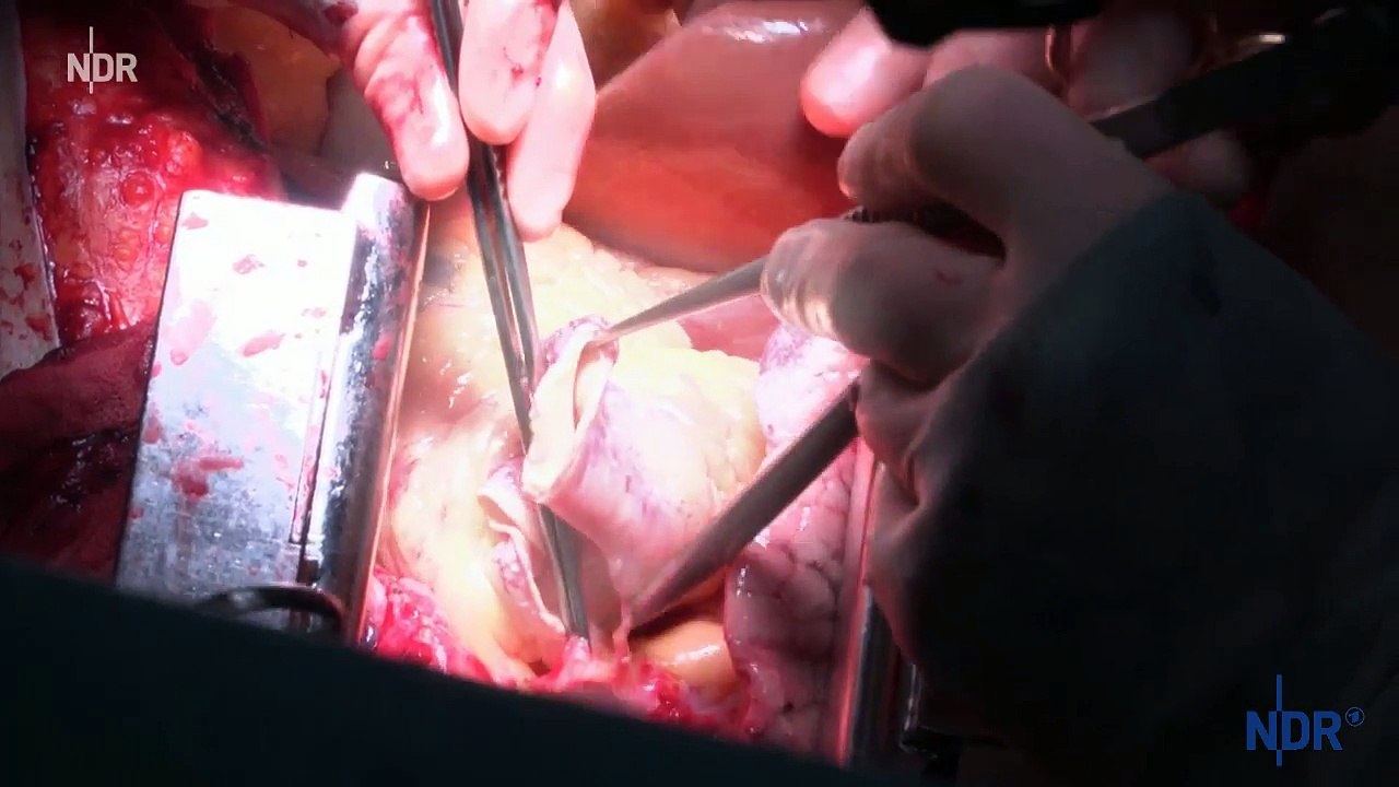 Die Lebensretter aus Hannover  Reportage über eine Lungentransplantation NDR