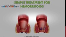 Hemoroid Doğal Tedavi | Basur Tedavisi  | Hemorrhoid Treatment
