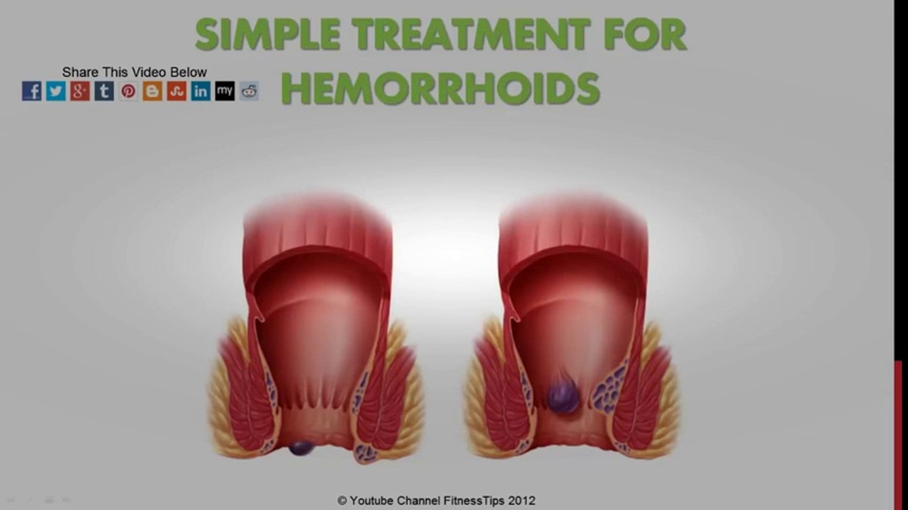 Hemoroid Doğal Tedavi | Basur Tedavisi  | Hemorrhoid Treatment