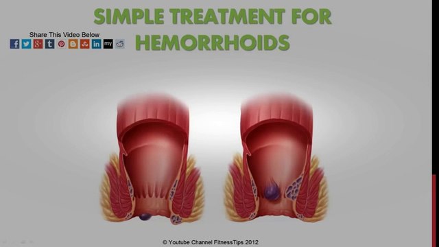 Hemoroid Doğal Tedavi | Basur Tedavisi | Hemorrhoid Treatment