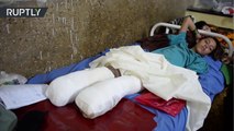 Niña afgana de 10 años pierde sus dos piernas al pisar una mina