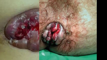 Hemorrhoids Natural Treatment | Hemorrhoid Treatment