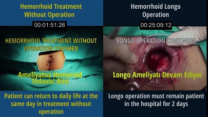 Hemorrhoid treatment without operation  and  Hemorrhoid longo operation | Hemorrhoid Treatment