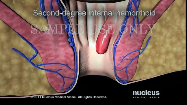 İç Hemoroid Ve Doğal olarak Evde İç Hemoroid Tedavisi Nasıl yapılır belirtileri? | Hemorrhoid Treatment