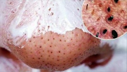 This Trick Can Get You Rid Of All The Annoying And Gross Blackheads Instantly!