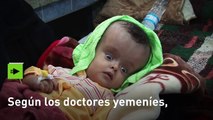 FUERTES IMÁGENES: En Yemen nacen más niños con deformidades a causa de la guerra