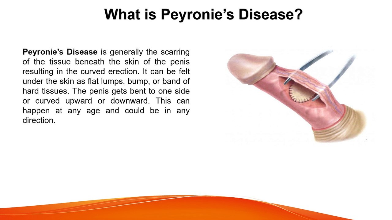 Peyronies Disease - All that you need to know