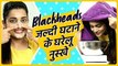 Blackheads जल्दी हटाने के घरेलू नुस्खे | Blackheads Removal At Home | Blackheads Treatment