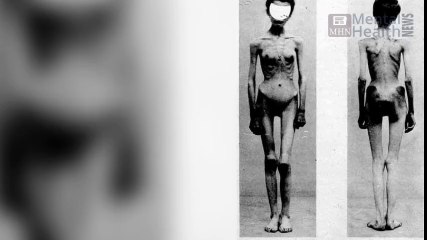 Understanding Anorexia Nervosa 🧠