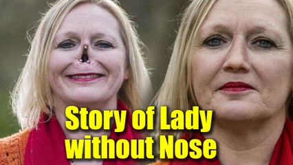 Real-Life Story of woman living life with a fake nose | Boldsky