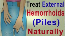 Treating External Hemorrhoids At Home - Hemorrhoids Home Treatment - Relief Recipes | Hemorrhoid Treatment