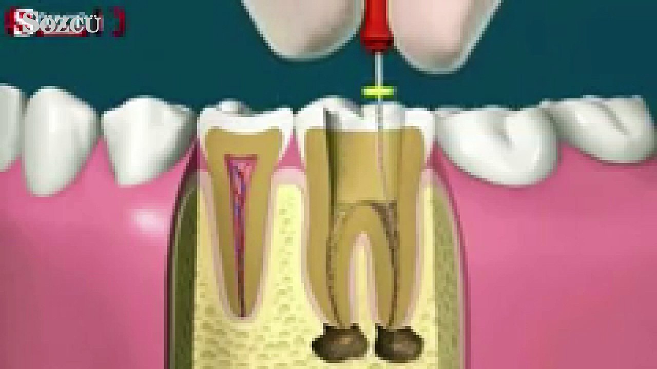 Kanal tedavisi nasıl yapılır Dailymotion Video