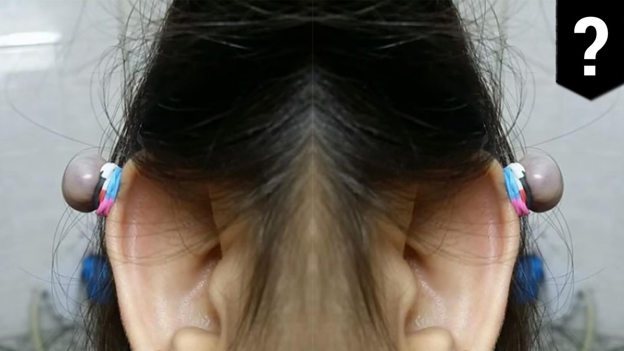 Cool way to remove keloid scars with a rubber band video Dailymotion