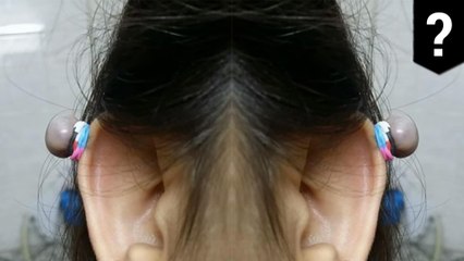 Cool way to remove keloid scars with a rubber band