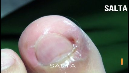 الساقين فيديو يتم علاج قرار الطبيب عن طريق إصلاح باديكير الاظافر من الظفر