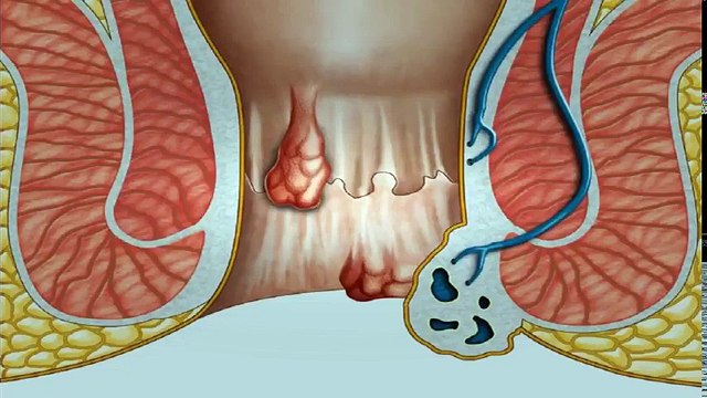 Prolapsed Hemorrhoids Treatment - Prolapsed Hemorrhoid Treatment At Home Without Surgery | Hemorrhoid Treatment
