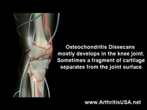 Knee pain due to Osteochondritis Dissecans by Dr Farshchian