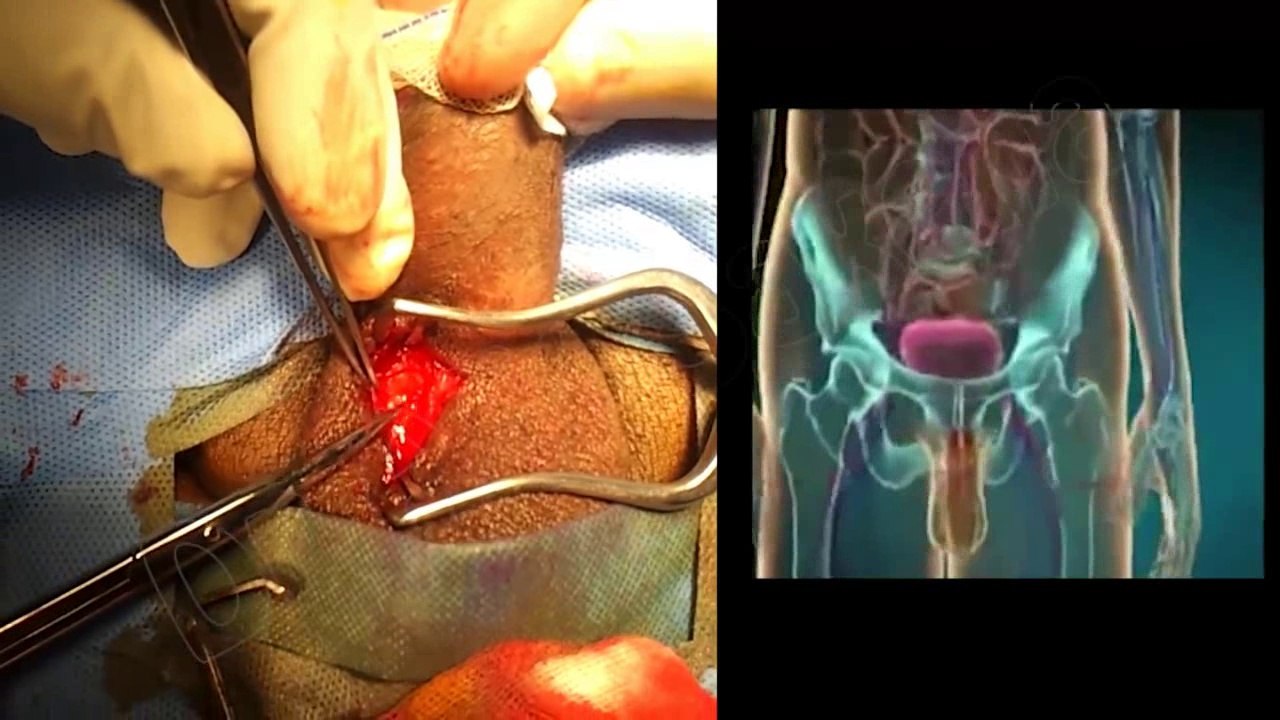 How Surgeon Cure Erectile Dysfunction (Inflatable Penile Prosthesis)