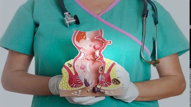 How To Get Rid Of Hemorrhoids Permanently - How To Get Rid Of Hemorrhoids Naturally | Hemorrhoid Treatment