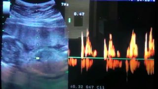 17 Week Gender Ultrasound