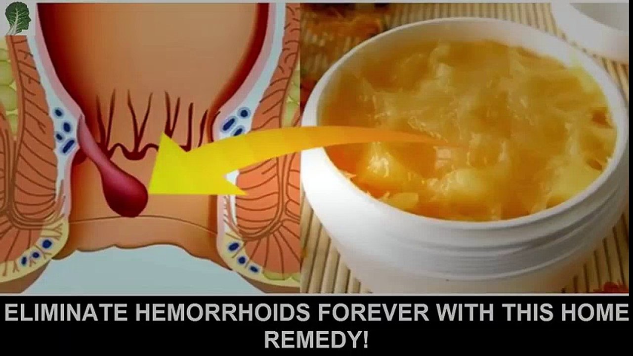 Eliminate Hemorrhoids Forever With This Home Remedy! | Hemorrhoid Treatment