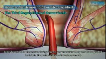 Hemorrhoids or Piles|Types|Surgical Treatment|Recovery Period | Hemorrhoid Treatment