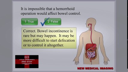 What is a Hemorrhoid? What Is The Cause of Hemorrhoids? Hemorrhoid Surgery Risk and Complication | Hemorrhoid Treatment