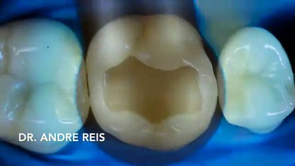 İzlemesi anlamsızca tatmin edici diş çürüğü tedavisi