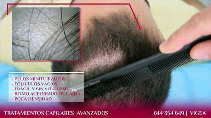 Tratamientos Capilares Avanzados en Almería y Granada