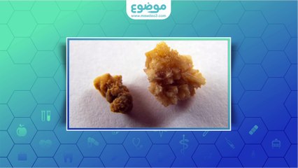 ما هي أعراض رمل الكلى